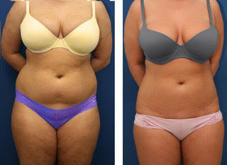 invisa-RED body contouring results