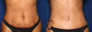 invisa-RED weight loss technology