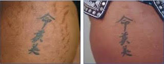 invisa-RED laser aesthetics certification